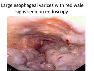 Upper GI Bleeding | PPTX