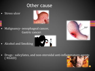 • Stress ulcer
• Malignancy- oesophageal cancer,
Gastric cancer.
• Alcohol and Smoking
• Drugs : salicylates, and non-steroidal anti-inflammatory agents
( NSAID)
Other cause
 