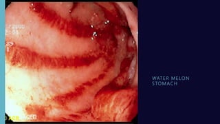 WAT E R M E LO N
S TO M AC H
 