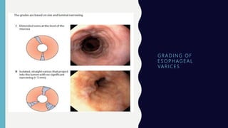G R A D I N G O F
E S O P H AG E A L
VA R I C E S
 