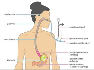 Upper GI Bleeding | PPTX