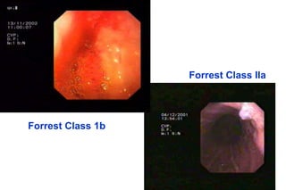 Forrest Class 1b
Forrest Class IIa
 