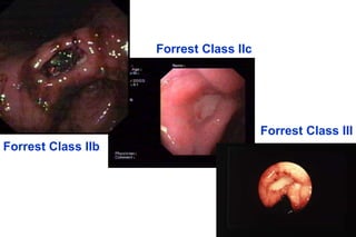 Forrest Class IIb
Forrest Class IIc
Forrest Class III
 