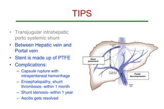 TIPS
• Transjugular intrahepatic
porto systemic shunt
• Between Hepatic vein and
Portal vein
• Stent is made up of PTFE
• Complications:
– Capsule rupture with
intraperitoneal hemorrhage
– Encephalopathy, shunt
thrombosis- within 1 month
– Shunt stenosis- within 1 year
– Ascitis gets resolved
 