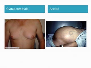 Gynaecomastia

Ascitis

 