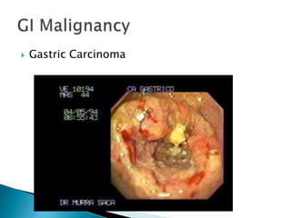 

Gastric Carcinoma

 