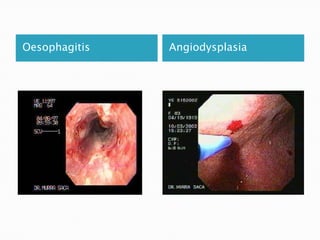 Oesophagitis

Angiodysplasia

 