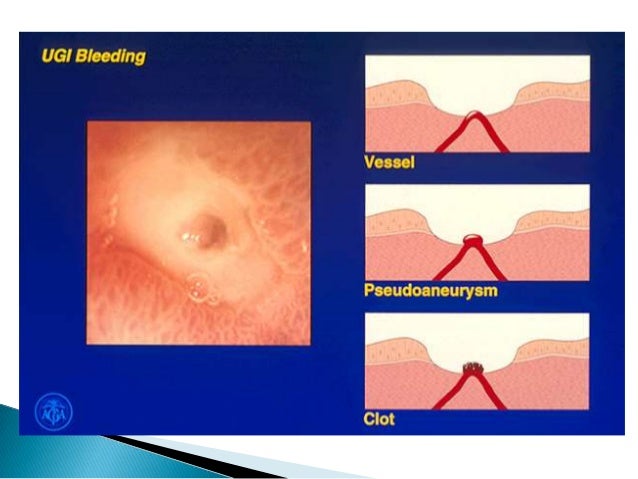 Approach To Patients With Upper Gi Bleeding Approach To Patients With Upper Gi Bleeding