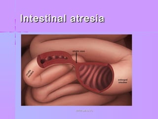 Intestinal atresiaIntestinal atresia
WWW.SMSO.CCWWW.SMSO.CC
 