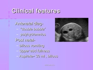 Clinical featuresClinical features
 Antenatal diag-Antenatal diag-
– ““double bubble”double bubble”
– polyhydramniospolyhydramnios
 Post natal-Post natal-
– bilious vomitingbilious vomiting
– Upper abd fullnessUpper abd fullness
– Aspirate> 30 ml , biliousAspirate> 30 ml , bilious
WWW.SMSO.CCWWW.SMSO.CC
 