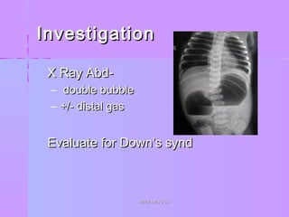 InvestigationInvestigation
 X Ray Abd-X Ray Abd-
– double bubbledouble bubble
– +/- distal gas+/- distal gas
 Evaluate for Down’s syndEvaluate for Down’s synd
WWW.SMSO.CCWWW.SMSO.CC
 