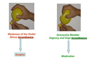 Weakness of the Outlet 
Stress iinnccoonnttiinneennccee 
Surgery 
Overactive Bladder 
Urgency and Urge iinnccoonnttiinneennccee 
Medication 
 