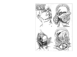 U hỗn hợp tuyến nước bọt