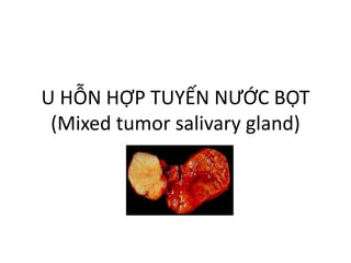 U HỖN HỢP TUYẾN NƯỚC BỌT
(Mixed tumor salivary gland)
 