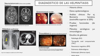 DIAGNOSTICO DE LAS HELMINTIASIS
• Historia clínica
• Datos epidemiológicos
• Análisis clínicos: Por ej.
Biometría hemática
(eosinofilia superior al 20%)
• Pruebas funcionales (de
órganos)
• Métodos serológicos y,o
inmunológicos
• Estudios de gabinete:
- Radiología (RX)
- Tomografía axial computarizada
(TAC)
- Resonancia magnética (RM)
- Exámenes oftalmológicos
- Endoscopia (diversos tipos)
- entre otros
Gnatostomiosis ocular
http://www.vacunasyviajes.es/vacunasyviajes/Gnathostomiasis_Atlas.html#8
http://emssolutionsint.blogspot.com/2012/12/cisticercosis-triptico.html
Neurocisticercosis (larvas como puntilleo
blanquecino)
RM
https://www.medigraphic.com/pdfs/neumo/nt-2014/nt144d.pdf
RX
TAC
Hidatidosis pulmonar
Colonoscopia
Tricocefalosis (se aprecian abundantes gusanos)
https://www.elsevier.es/es-revista-endoscopia-335-articulo-diagnostico-
incidental-tricocefalosis-mediante-colonoscopia-X0188989313270226
 