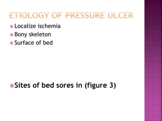  Localize ischemia
 Bony skeleton
 Surface of bed
Sites of bed sores in (figure 3)
 