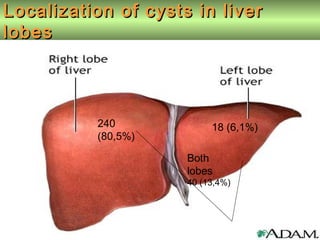 Localization of cysts in liverLocalization of cysts in liver
lobeslobes
240
(80,5%)
18 (6,1%)
Both lobes –
40 (13,4%)
Both
lobes
40 (13,4%)
 
