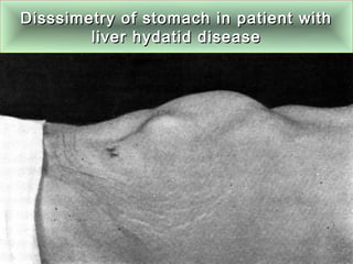 Disssimetry of stomach in patient withDisssimetry of stomach in patient with
liver hydatid diseaseliver hydatid disease
 