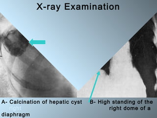 A- Calcination of hepatic cyst B- High standing of the
right right dome of a
diaphragm
X-ray Examination
 