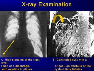 X-ray Examination
A- High standing of the right B- Calcinated cyst with a
level
dome of a diaphragm of gas - an attribute of the
with exudate in pleura cysto-biliary fistulas
 