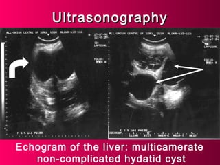 UltrasonographyUltrasonography
Echogram of the liver: multicamerate
non-complicated hydatid cyst
 