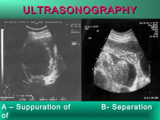 ULTRASONOGRAPHYULTRASONOGRAPHY
A – Suppuration of B- Separation
of
 