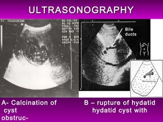 ULTRASONOGRAPHYULTRASONOGRAPHY
A- Calcination of B – rupture of hydatid
cyst hydatid cyst with
obstruc-
Bile
ducts
 