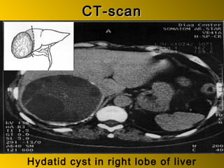 CT-scanCT-scan
Hydatid cyst in right lobe of liver
 
