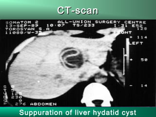 CT-scanCT-scan
Suppuration of liver hydatid cyst
 