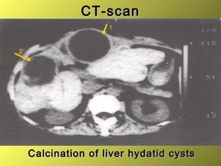 CT-scanCT-scan
Calcination of liver hydatid cystsCalcination of liver hydatid cysts
1
2
 