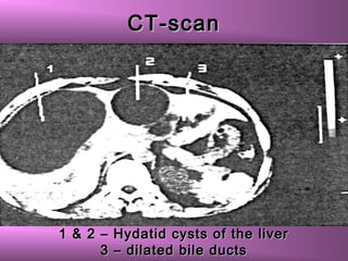 CT-scanCT-scan
1 & 2 – Hydatid cysts of the liver1 & 2 – Hydatid cysts of the liver
3 – dilated bile ducts3 – dilated bile ducts
 
