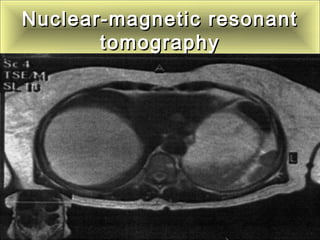 Nuclear-magnetic resonantNuclear-magnetic resonant
tomographytomography
 