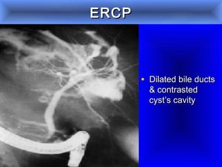 ERCPERCP
• Dilated bile ductsDilated bile ducts
& contrasted& contrasted
cyst’s cavitycyst’s cavity
 