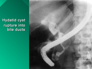 ERCPERCP
Hydatid cystHydatid cyst
rupture intorupture into
bile ductsbile ducts
 