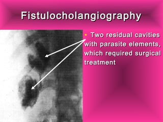 FistulocholangiographyFistulocholangiography
• Two residual cavitiesTwo residual cavities
with parasite elements,with parasite elements,
which required surgicalwhich required surgical
treatmenttreatment
 