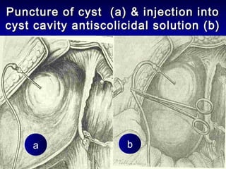 Puncture of cyst (a) & injection intoPuncture of cyst (a) & injection into
cyst cavity antiscolicidal solution (b)cyst cavity antiscolicidal solution (b)
a b
 