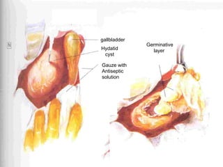 Germinative
layer
Gauze with
Antiseptic
solution
Hydatid
cyst
gallbladder
 