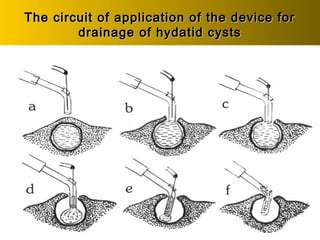 The circuit of application of the device forThe circuit of application of the device for
drainage of hydatid cystsdrainage of hydatid cysts
 