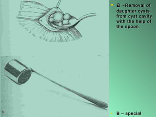 • a -a -Removal ofRemoval of
daughter cystsdaughter cysts
from cyst cavityfrom cyst cavity
with the help ofwith the help of
the spoonthe spoon
• B – specialB – special
 