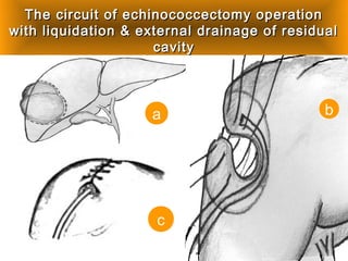The circuit of echinococcectomy operationThe circuit of echinococcectomy operation
with liquidation & external drainage of residualwith liquidation & external drainage of residual
cavitycavity
a b
c
 