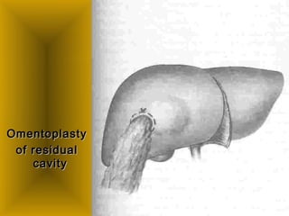 OmentoplastyOmentoplasty
of residualof residual
cavitycavity
 