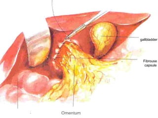 gallbladder
Fibrouse
capsule
 