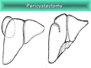 PericystectomyPericystectomy
 