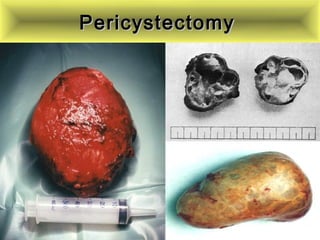 PericystectomyPericystectomy
 