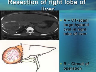 Resection of right lobe ofResection of right lobe of
liverliver
• A – CT-scan:A – CT-scan:
large hydatidlarge hydatid
cyst in rightcyst in right
lobe of liverlobe of liver
• B – Circuit ofB – Circuit of
operationoperation
 