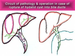 Circuit of pathology & operation in case ofCircuit of pathology & operation in case of
rupture of hydatid cyst into bile ductsrupture of hydatid cyst into bile ducts
 