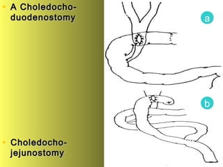 • A Choledocho-A Choledocho-
duodenostomyduodenostomy
• Choledocho-Choledocho-
jejunostomyjejunostomy
a
b
 