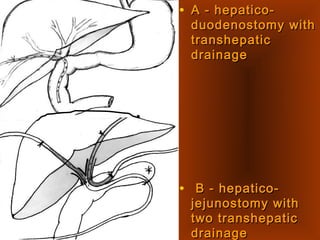 • A - hepatico-A - hepatico-
duodenostomy withduodenostomy with
transhepatictranshepatic
drainagedrainage
• B - hepatico-B - hepatico-
jejunostomy withjejunostomy with
two transhepatictwo transhepatic
drainagedrainage
 