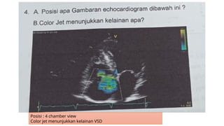 Vsd Color Comprehensive Cardiac Echo and ECG Interpretation Training | PPTX