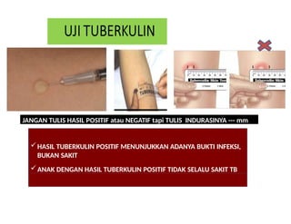 Tubercolin Uji tuberkulin Mantoux Test pada penderita Tuberculosis | PPTX